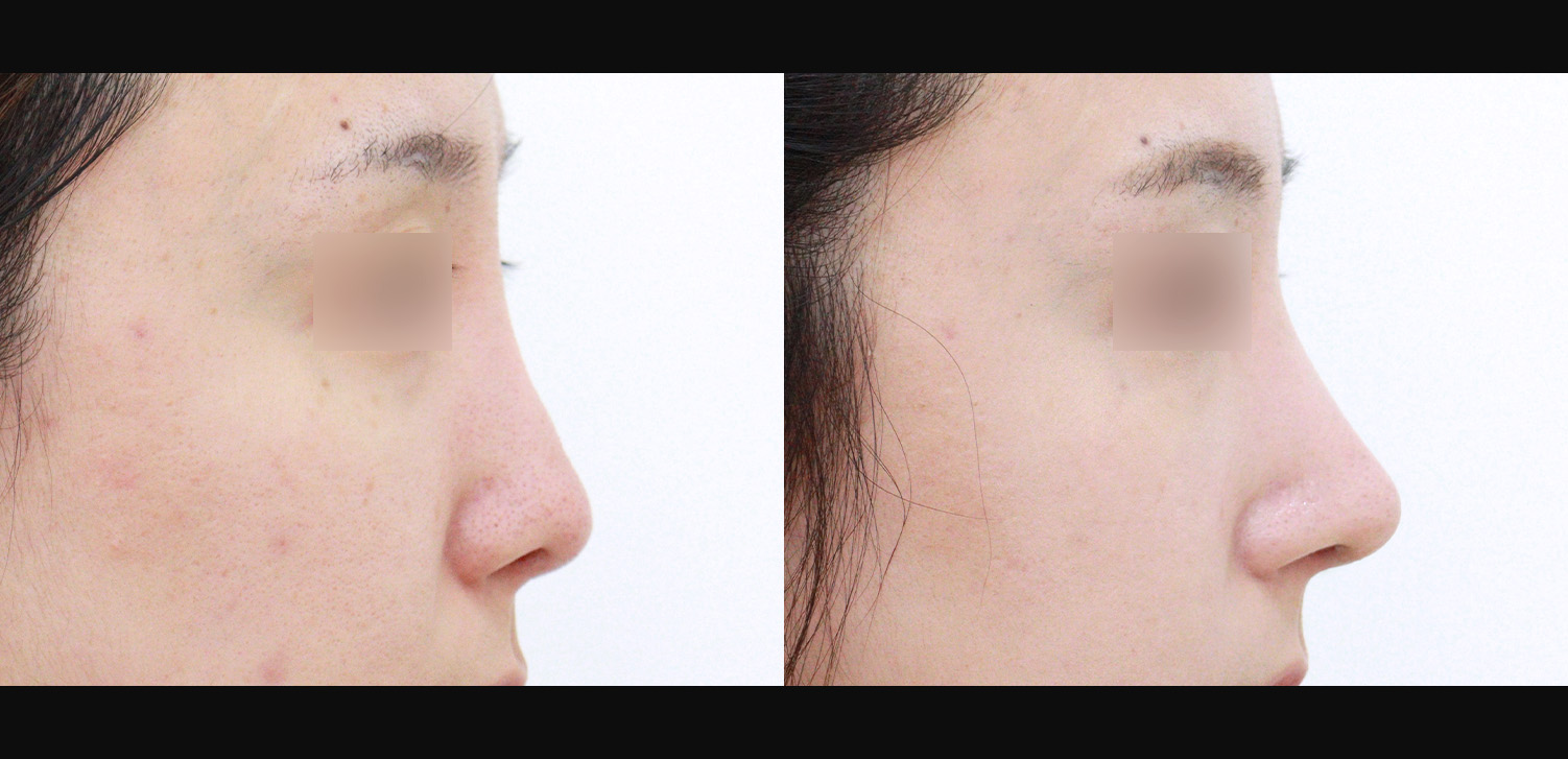 3D코성형 재수술(화살코+휜코+기능코)