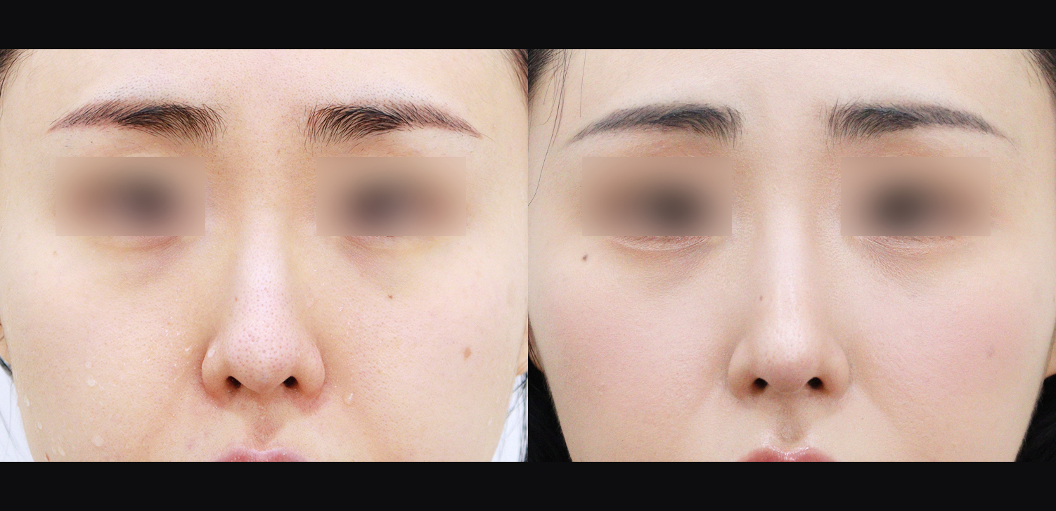 3D 코성형(콧대+코끝+인중코)