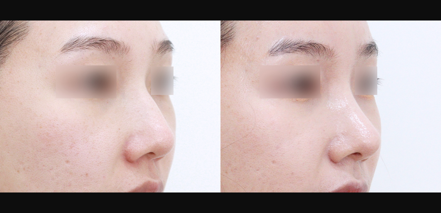 코끝+인중코+매부리+기능코