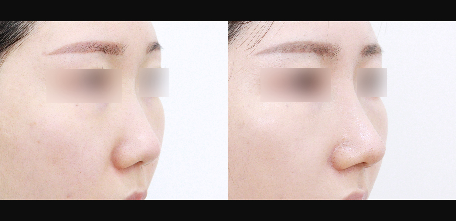 3D 코성형(콧대+코끝+들창코+인중코)