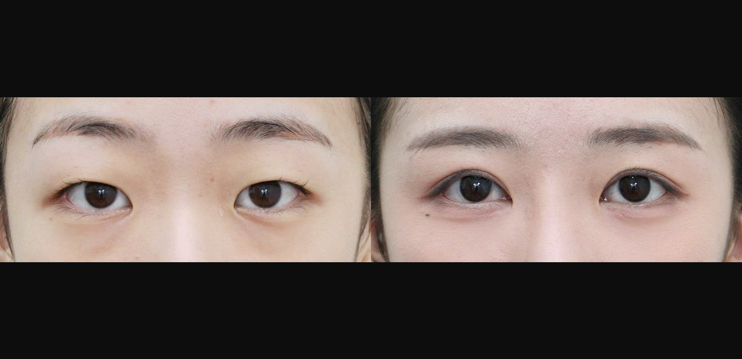 절개 쌍꺼풀 + 트임