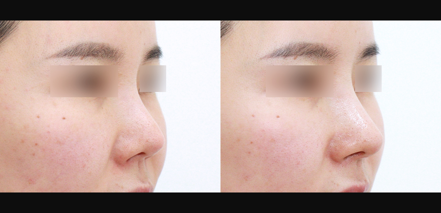 3D코성형 재수술(들창코+찝힌코+인중코)