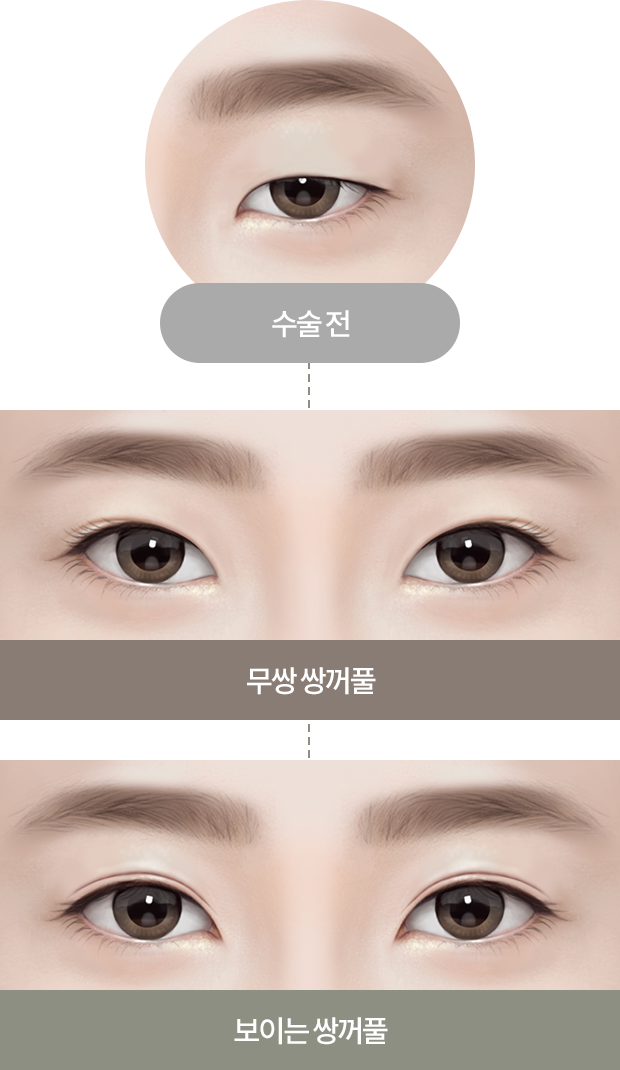 수술전/무쌍 쌍꺼풀/보이는 쌍꺼풀 사진